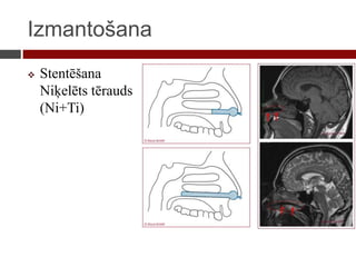 Izmantošana
 Stentēšana
Niķelēts tērauds
(Ni+Ti)
 
