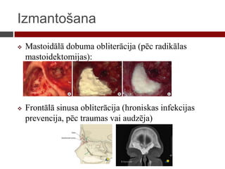Izmantošana
 Mastoidālā dobuma obliterācija (pēc radikālas
mastoidektomijas):
 Frontālā sinusa obliterācija (hroniskas infekcijas
prevencija, pēc traumas vai audzēja)
 