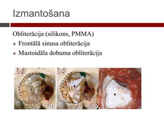 Izmantošana
Obliterācija (silikons, PMMA)
 Frontālā sinusa obliterācija
 Mastoidāla dobuma obliterācija
 