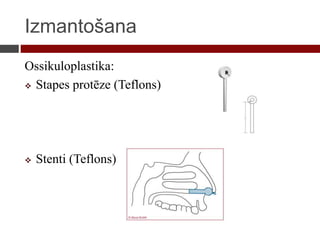 Izmantošana
Ossikuloplastika:
 Stapes protēze (Teflons)
 Stenti (Teflons)
 