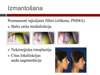 Izmantošana
Permamenti injicējami filleri (silikons, PMMA)
 Balss saišu medializācija
 Neķirurģiska rinoplastija
 Citas lokalizācijas
audu augmentācija
 