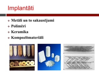Implantāti
 Metāli un to sakausējumi
 Polimēri
 Keramika
 Kompozītmateriāli
 