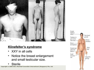 91Copyright © 2006-2011 Marshall Cavendish International (Singapore) Pte. Ltd.
Klinefelter’s syndrome
• XXY in all cells
• Notice the breast enlargement
and small testicular size.
• Sterile
 