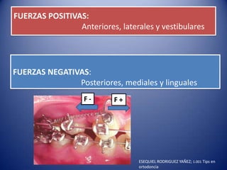 FUERZAS POSITIVAS:
                Anteriores, laterales y vestibulares




FUERZAS NEGATIVAS:
               Posteriores, mediales y linguales
                   F-      F+




                                  ESEQUIEL RODRIGUEZ YAÑEZ; 1.001 Tips en
                                  ortodoncia
 