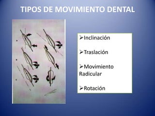 TIPOS DE MOVIMIENTO DENTAL


             Inclinación

             Traslación

             Movimiento
             Radicular

             Rotación
 