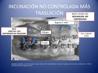 INCLINACIÓN NO CONTROLADA MÁS
                TRASLACIÓN                                                                               MC/F= 0/150= 0/1
                                                                                                         INCLINACION NO
                                                                                                           CONTROLADA
                   1500 grmsf. mm                                            0 grms f. mm

         MC/F
     1500/150= 10/1
MOVIMIENTO DE TRALACION
                                                        150 grs.
                                                                                            -
                                                                                                                       Arco redondo
                                                                                                                           0.018

                                  +                     7 mm




        Samuels, and cols. A clinical study of space closure with nickel-titanium closed coil springs and an elastic module; Am J Orthod
        Dentofacial Orthop 1998;114:73-9.)
 