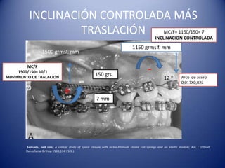 INCLINACIÓN CONTROLADA MÁS
                   TRASLACIÓN                                                                         MC/F= 1150/150= 7
                                                                                                  INCLINACION CONTROLADA
                                                                                  1150 grms f. mm
                   1500 grmsf. mm

         MC/F
     1500/150= 10/1
MOVIMIENTO DE TRALACION
                                                        150 grs.
                                                                                            -
                                                                                                                    Arco de acero
                                                                                                                    0,017X0,025

                                  +                     7 mm




        Samuels, and cols. A clinical study of space closure with nickel-titanium closed coil springs and an elastic module; Am J Orthod
        Dentofacial Orthop 1998;114:73-9.)
 