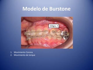 Modelo de Burstone

                          150grs. f




1. Movimiento Corona
2. Movimiento de torque
 