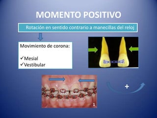 MOMENTO POSITIVO
  Rotación en sentido contrario a manecillas del reloj


Movimiento de corona:

Mesial
Vestibular



                                                 +
 