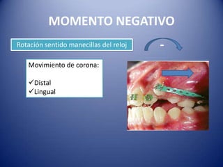 MOMENTO NEGATIVO
Rotación sentido manecillas del reloj   -
   Movimiento de corona:

   Distal
   Lingual
 