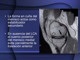 • La forma en cuña del 
menisco actúa como 
estabilizador 
secundario 
• En ausencia del LCA 
el cuerno posterior 
del menisco medial 
evita parcialmente la 
traslación anterior 
 