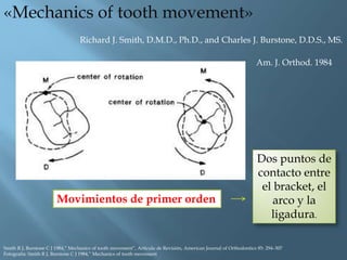 Movimientos de primer orden
«Mechanics of tooth movement»
Richard J. Smith, D.M.D., Ph.D., and Charles J. Burstone, D.D.S., MS.
Am. J. Orthod. 1984
Smith R J, Burstone C J 1984,” Mechanics of tooth movement”, Artículo de Revisión, American Journal of Orthodontics 85: 294–307
Fotografía: Smith R J, Burstone C J 1984,” Mechanics of tooth movement
Dos puntos de
contacto entre
el bracket, el
arco y la
ligadura.
 