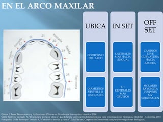 EN EL ARCO MAXILAR
UBICA
CONTORNO
DEL ARCO
DIAMETROS
VESTIBULO
LINGUALES
IN SET
LATERALES
MAS HACIA
LINGUAL
B. I.
CENTRALES
MAS
GRUESOS
OFF
SET
CANINOS
LEVE
CURVATURA
HACIA
AFUERA
MOLARES
BAYONETA
CUSPIDES
MV
SOBRESALEN
Quiros J: Bases Biomecánicas y Aplicaciones Clínicas en Ortodoncia Interceptiva: Amolca, 2006
Uribe Restrepo Gonzalo A, “Ortodoncia teorica y clinica”, 2da Edición, Corporación Interamericana para investigaciones biológicas, Medellín – Colombia, 2010
Fotografía: Uribe Restrepo Gonzalo A, “Ortodoncia teorica y clinica”, 2da Edición, Corporación Interamericana para investigaciones biológicas,.
 