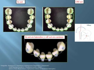 In set en laterales y off set en caninos
In set Off set
Fotografías: Rodriguez E, “Ortodoncia Contemporanea Diagnóstico y Tratamiento”
Uribe Restrepo Gonzalo A, “Ortodoncia teorica y clinica”
Quiros J: Bases Biomecánicas y Aplicaciones Clínicas en Ortodoncia Interceptiva
 
