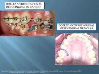 DOBLEZ ANTIRROTACIONAL
DISTOLINGUAL DE CANINO
DOBLEZ ANTIRROTACIONAL
MESIOLINGUAL DE MOLAR
Fotografías: Registros de fichas de alta de Clínica de Postgrado de Ortodoncia, Universidad de Cuenca, Dr. Andrés Barragán , 2012
Uribe Restrepo Gonzalo A, “Ortodoncia teorica y clinica
 
