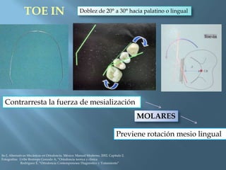 TOE IN Doblez de 20° a 30° hacia palatino o lingual
Contrarresta la fuerza de mesialización
MOLARES
Previene rotación mesio lingual
Ito J, Alternativas Mecánicas en Ortodoncia. México: Manual Moderno, 2002. Capítulo 2.
Fotografías: Uribe Restrepo Gonzalo A, “Ortodoncia teorica y clinica
Rodriguez E, “Ortodoncia Contemporanea Diagnóstico y Tratamiento”
 