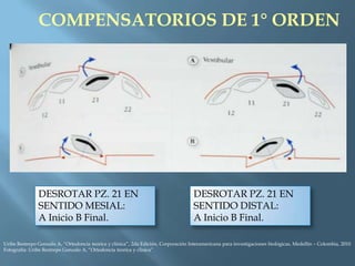COMPENSATORIOS DE 1° ORDEN
DESROTAR PZ. 21 EN
SENTIDO MESIAL:
A Inicio B Final.
DESROTAR PZ. 21 EN
SENTIDO DISTAL:
A Inicio B Final.
Uribe Restrepo Gonzalo A, “Ortodoncia teorica y clinica”, 2da Edición, Corporación Interamericana para investigaciones biológicas, Medellín – Colombia, 2010
Fotografía: Uribe Restrepo Gonzalo A, “Ortodoncia teorica y clinica”
 