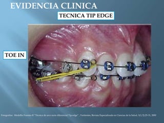 EVIDENCIA CLINICA
TOE IN
TECNICA TIP EDGE
Fotografías: Medellín Fuentes R “Técnica de arco recto diferencial Tip-edge” , Vertientes, Revista Especializada en Ciencias de la Salud, 3(1/2):25-31, 2000
 