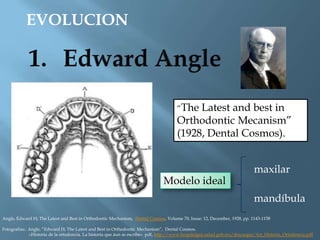 EVOLUCION
“The Latest and best in
Orthodontic Mecanism”
(1928, Dental Cosmos).
Modelo ideal
maxilar
mandíbula
Angle, Edward H; The Latest and Best in Orthodontic Mechanism, Dental Cosmos, Volume 70, Issue: 12, December, 1928, pp. 1143-1158
Fotografías:. Angle, “Edward H; The Latest and Best in Orthodontic Mechanism”, Dental Cosmos.
«Historia de la ortodoncia. La historia que áun se escribe» pdf, http://www.hospitalgea.salud.gob.mx/descargas/Art_Historia_Ortodoncia.pdf
 