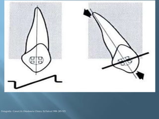 Fotografía : Canut JA: Ortodoncia Clinica. Ed Salvat 1988: 285-323
 