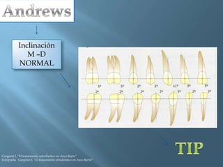Inclinación
M –D
NORMAL
Gregoret J, “El tratamiento ortodóntico en Arco Recto”
Fotografía : Gregoret J, “El tratamiento ortodóntico en Arco Recto”
 