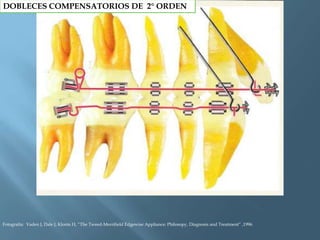 DOBLECES COMPENSATORIOS DE 2° ORDEN
Fotografía: Vaden J, Dale J, Klonts H, “The Tweed-Merrifield Edgewise Appliance: Philosopy, Diagnosis and Treatment” ,1996.
 
