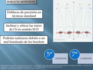 DOBLECES ARTISTICOS
Dobleces de precisión en
técnicas standard
Inclinar y ubicar las raíces
de I S en sentido M D
Podrían realizarse debido a un
mal bondeado de los brackets
CENTRALES
5° LATERALES
7°
Uribe Restrepo Gonzalo A, “Ortodoncia teorica y clinica”, 2da Edición, Corporación Interamericana para investigaciones biológicas, Medellín – Colombia, 2010
Rodriguez E, “Ortodoncia Contemporanea Diagnóstico y Tratamiento”, México 2da Edición, Amolca, 2008
Fotografía: Uribe Restrepo Gonzalo A, “Ortodoncia teorica y clinica”,
 