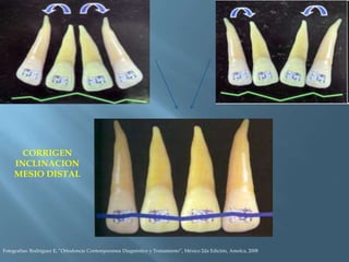 CORRIGEN
INCLINACION
MESIO DISTAL
Fotografías: Rodriguez E, “Ortodoncia Contemporanea Diagnóstico y Tratamiento”, México 2da Edición, Amolca, 2008
 