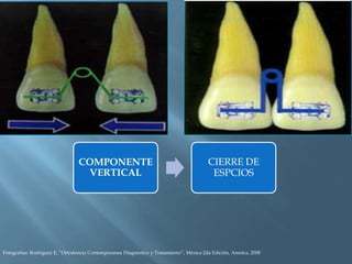 COMPONENTE
VERTICAL
CIERRE DE
ESPCIOS
Fotografías: Rodriguez E, “Ortodoncia Contemporanea Diagnóstico y Tratamiento”, México 2da Edición, Amolca, 2008
 