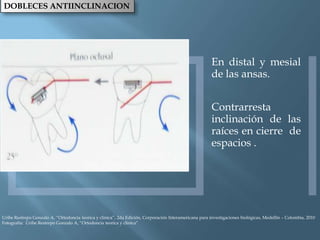 DOBLECES ANTIINCLINACION
En distal y mesial
de las ansas.
Contrarresta
inclinación de las
raíces en cierre de
espacios .
Uribe Restrepo Gonzalo A, “Ortodoncia teorica y clinica”, 2da Edición, Corporación Interamericana para investigaciones biológicas, Medellín – Colombia, 2010
Fotografía: Uribe Restrepo Gonzalo A, “Ortodoncia teorica y clinica”
 