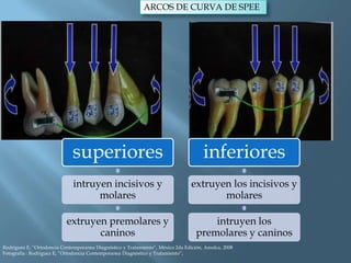 ARCOS DE CURVA DE SPEE
superiores
intruyen incisivos y
molares
extruyen premolares y
caninos
inferiores
extruyen los incisivos y
molares
intruyen los
premolares y caninos
Rodriguez E, “Ortodoncia Contemporanea Diagnóstico y Tratamiento”, México 2da Edición, Amolca, 2008
Fotografía : Rodriguez E, “Ortodoncia Contemporanea Diagnóstico y Tratamiento”,
 