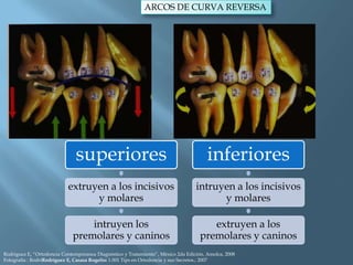 ARCOS DE CURVA REVERSA
superiores
extruyen a los incisivos
y molares
intruyen los
premolares y caninos
inferiores
intruyen a los incisivos
y molares
extruyen a los
premolares y caninos
Rodriguez E, “Ortodoncia Contemporanea Diagnóstico y Tratamiento”, México 2da Edición, Amolca, 2008
Fotografía : RodriRodríguez E, Casasa Rogelio: 1.001 Tips en Ortodoncia y sus Secretos.; 2007
 
