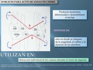DOBLECES PARA ACTIVAR ANSAS DE CIERRE
DEPENDE DE:
Producen momentos
diferenciales y desestabilizan
el anclaje
sitio en donde se ubiquen,
de la magnitud, el calibre y la
aleación de los alambres
Retracción individual de los caninos durante el cierre de espacios.
Uribe Restrepo Gonzalo A, “Ortodoncia teorica y clinica”, 2da Edición, Corporación Interamericana para investigaciones biológicas, Medellín – Colombia, 2010
Fotografía: Uribe Restrepo Gonzalo A, “Ortodoncia teorica y clinica”
 