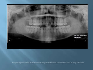 Fotografía: Registros de fichas de alta de Clínica de Postgrado de Ortodoncia, Universidad de Cuenca, Dr. Diego Toledo, 2013
 