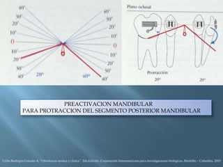 PREACTIVACION MANDIBULAR
PARA PROTRACCION DEL SEGMENTO POSTERIOR MANDIBULAR
Uribe Restrepo Gonzalo A, “Ortodoncia teorica y clinica”, 2da Edición, Corporación Interamericana para investigaciones biológicas, Medellín – Colombia, 2010
 