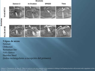 5 tipos de arcos:
Nitinol
Orthonol
Rematian lite
Niti clásico
Stainles Steel
(todos rectangulares a excepción del primero).
Glenys A. Thorstenson, B,. Kusy R, “Effect of archwire size and material on the resistance to sliding of self ligating brackets with second-order angulation in the d
revision, American Journal of Orthodontics and Dentofacial Orthopedics, 2002
 