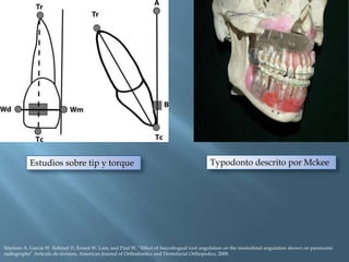 Estudios sobre tip y torque
Mariano A. Garcia W. Raboud D, Ernest W. Lam, and Paul W. “Effect of buccolingual root angulation on the mesiodistal angulation shown on panoramic
radiographs” Artículo de revision, American Journal of Orthodontics and Dentofacial Orthopedics, 2008.
Typodonto descrito por Mckee
 
