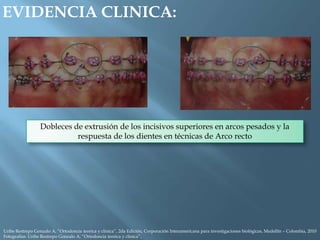 EVIDENCIA CLINICA:
Dobleces de extrusión de los incisivos superiores en arcos pesados y la
respuesta de los dientes en técnicas de Arco recto
Uribe Restrepo Gonzalo A, “Ortodoncia teorica y clinica”, 2da Edición, Corporación Interamericana para investigaciones biológicas, Medellín – Colombia, 2010
Fotografías: Uribe Restrepo Gonzalo A, “Ortodoncia teorica y clinica”,
 
