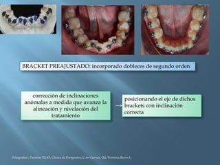 BRACKET PREAJUSTADO: incorporado dobleces de segundo orden
corrección de inclinaciones
anómalas a medida que avanza la
alineación y nivelación del
tratamiento
posicionando el eje de dichos
brackets con inclinación
correcta
Fotografías . Paciente TGAF, Clínica de Postgrados, U de Cuenca, Od. Verónica Bravo L.
 