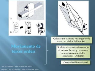 Movimiento de
tercer orden
Colocar un alambre rectangular de
canto en el slot del bracket.
Si el alambre se torsiona sobre
si mismo, la raíz y la corona
se mueven en sentidos
opuestos (TORQUE)
Control tridimensional
Canut JA: Ortodoncia Clinica. Ed Salvat 1988: 285-323
Fotografía : Canut JA: Ortodoncia Clinica. Ed Salvat 1988: 285-323
 