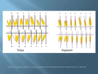 De Sousa V, “O aparelho pré-ajustado: sua evolução e suas prescrições” Revista Dental Press Ortodoncia y Ortopedia Facial 112 v. 11, 2006, Brasil
 