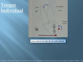 Torque
Individual
para mover la raíz de un solo diente
Fotografías: Uribe Restrepo Gonzalo A, “Ortodoncia teorica y clinica”, 2da Edición, Corporación Interamericana para investigaciones biológicas, Medellín – Colom
 