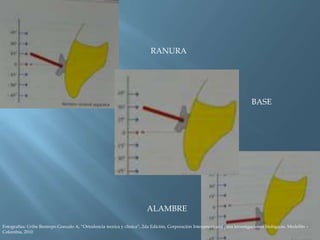 RANURA
BASE
ALAMBRE
Fotografías: Uribe Restrepo Gonzalo A, “Ortodoncia teorica y clinica”, 2da Edición, Corporación Interamericana para investigaciones biológicas, Medellín –
Colombia, 2010
 
