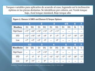 Torques variables para aplicarlos de acuerdo al caso, logrando así la inclinación
óptima en las piezas dentarias. Se identifican por colores, así: Verde torque
bajo, Azul torque standard, Rojo torque alto
Thomas W, “Variable Torque, for optimal inclination”, artículo de revisión, ci VOL 17 • NO 1• 2009
 