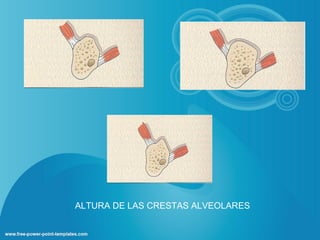 ALTURA DE LAS CRESTAS ALVEOLARES
 