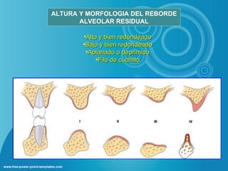 ALTURA Y MORFOLOGIA DEL REBORDE
       ALVEOLAR RESIDUAL

       •Alto y bien redondeado
       •Bajo y bien redondeado
        •Aplanado o deprimido
            •Filo de cuchillo
 