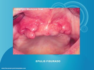 EPULIS FISURADO
 