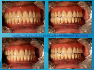CONTACTOS OCLUSALES EN MIC y MOVIMIENTOS EXCENTRICOS




                                                B. W. R.
 