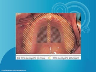 Biomecanica en protesis total dental