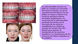 Labio Reposo biomecanica presentacion de tarea biomecanica 3 | PPTX